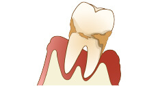 かみ合わせと歯周病の関係