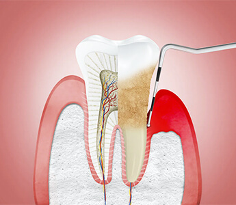 歯周病 Periodontal