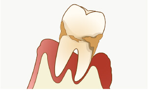 歯周病による口臭