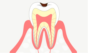 軽度の虫歯