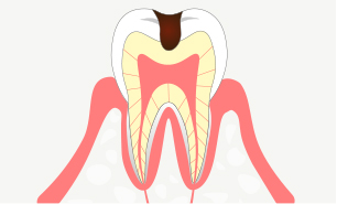 中度の虫歯