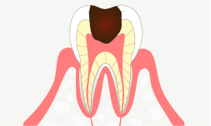 重度の虫歯