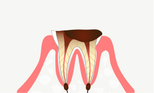 末期の虫歯