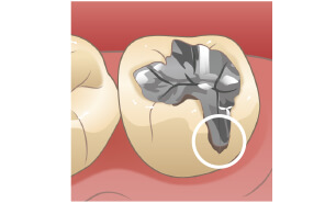 詰め物の下の虫歯に要注意
