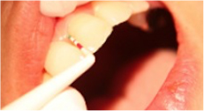 2．歯周病の検査