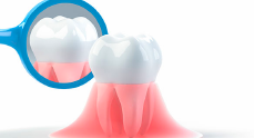歯周病、歯肉炎の改善・予防