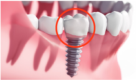 インプラント上部構造