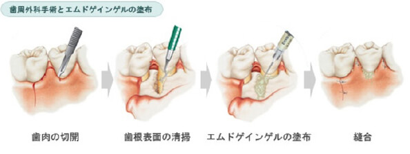 歯周組織の再生療法