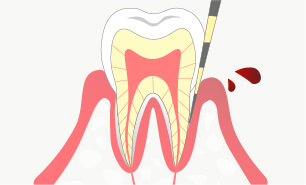 歯茎からの出血の検査