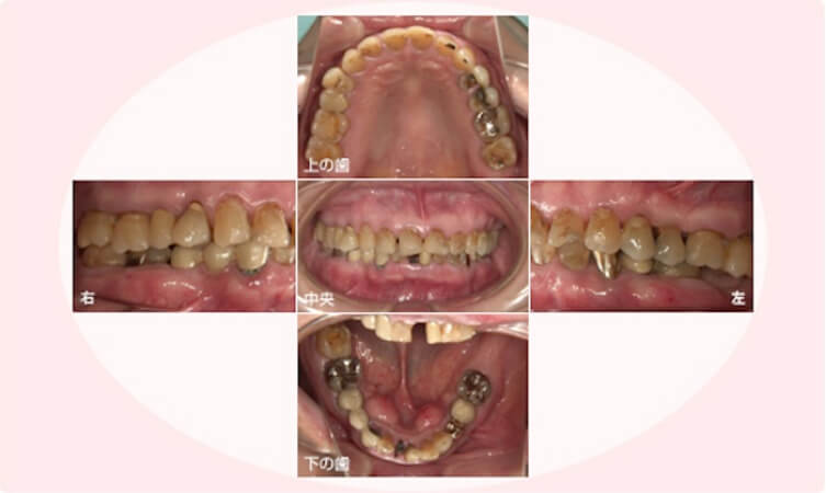 お口の中の状態を写真で確認