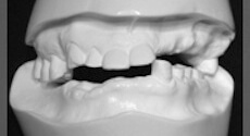 お口の中の歯型とり（診断用模型）
